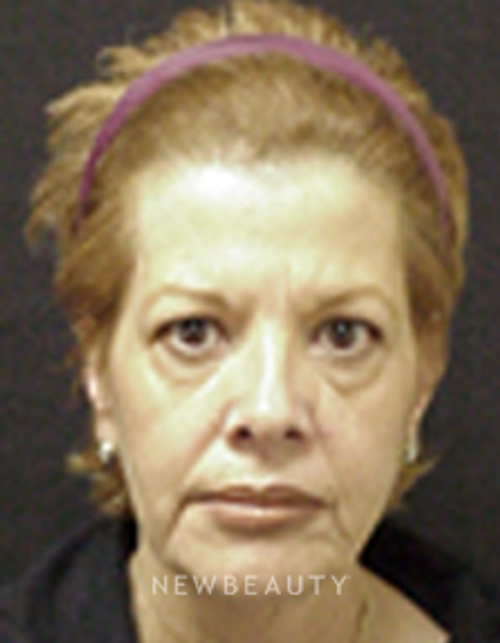 Dr. Mokhtar Asaadi Eyelid Lift, Facelift, Necklift - Before