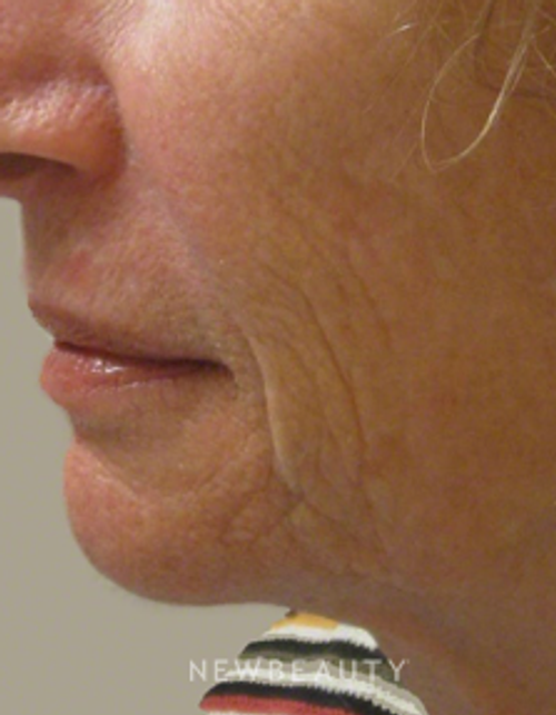 Dr. Kally Papantoniou - Ulthera - After