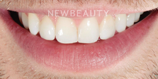 Dr. Nathan Hoffman - Invisalign & Teeth Whitening - After