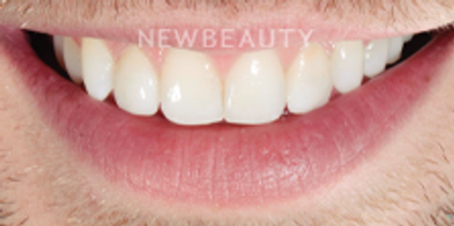 Dr. Nathan Hoffman - Invisalign & Teeth Whitening - After