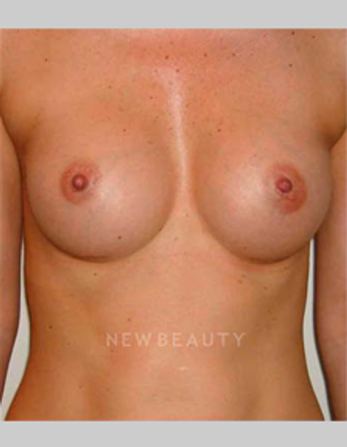 Dr. Michael Horn Silicone Breast Implants - After
