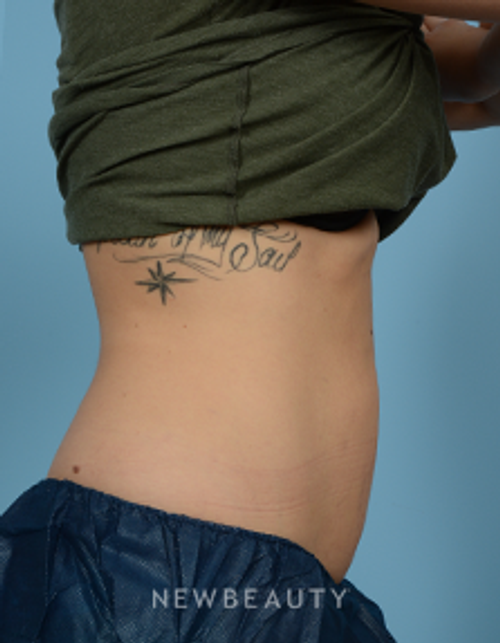 Dr. Jeffrey Wise - CoolSculpting - After