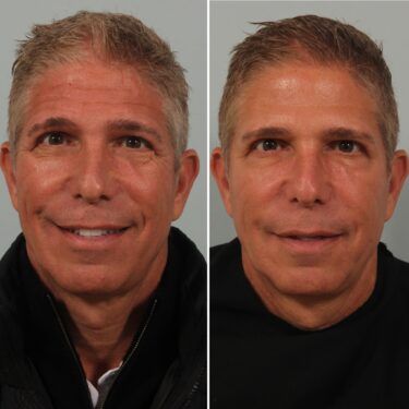 Male Injectables Gallery Dr. Beer Male