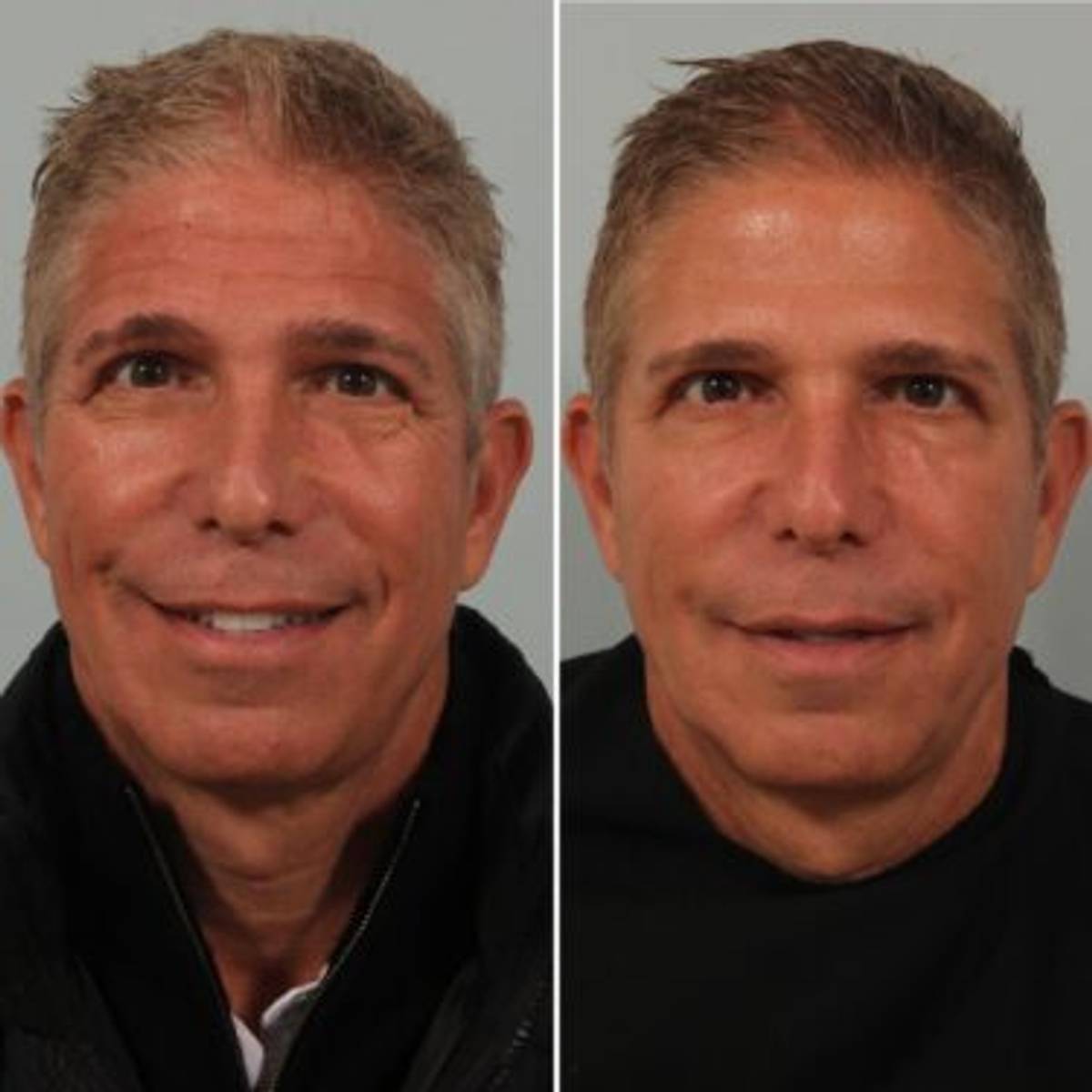 Male Injectables Gallery Dr. Beer Male