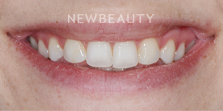 Dr. Nathan Hoffman - Invisalign - Before