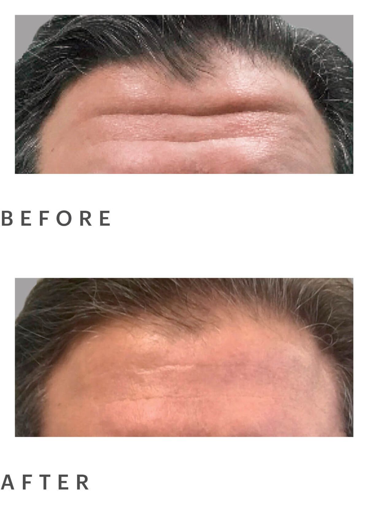 Birmingham, AL dermatologist Corey Hartman, MD used Juvéderm Vollure to restore lost volume in this 53-year-old male patient’s forehead.