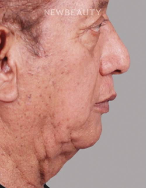 Dr. Paul Nassif - Facelift &Necklift - 51351682 - Before