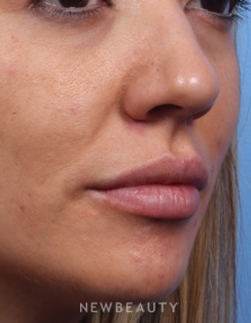 Dr. Kelly Bomer - Lip Filler - After