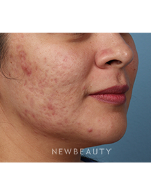 Dr. Kathleen Behr - PicoSure - Before