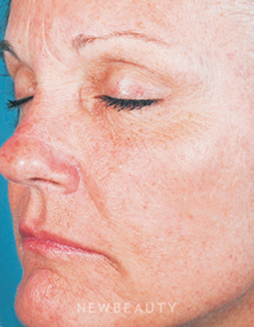 Dr. Girish Munavalli Acne Scar Treatment - After