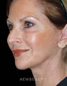 Dr. Min S. Ahn - Lower Facelift and Necklift - After