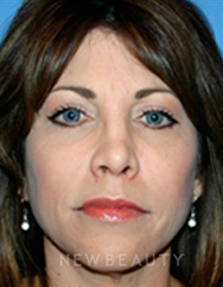 Dr. Kelly Bomer Liquid Facelift - After