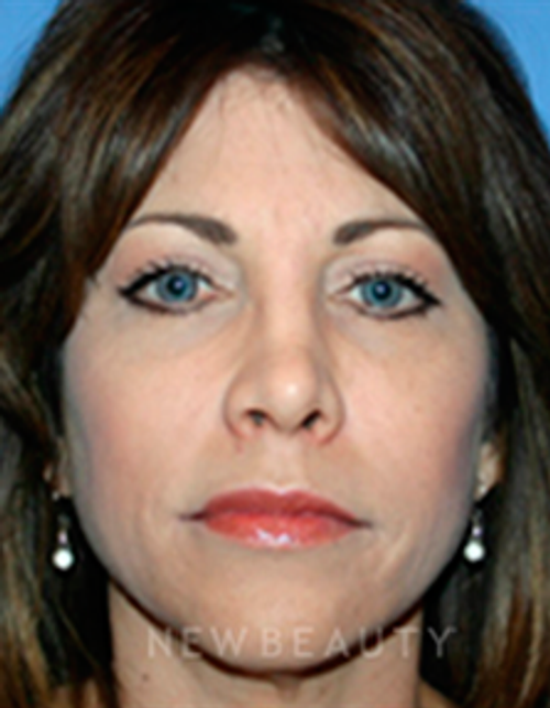 Dr. Kelly Bomer Liquid Facelift - After