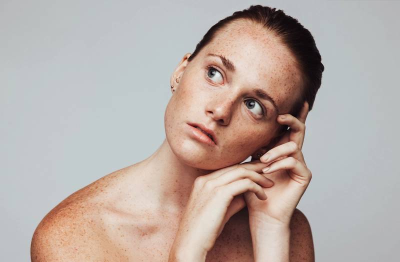 Can Adult Acne Signal Something More? Exploring the Acne and PCOS Connection
