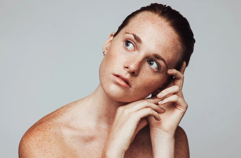 Can Adult Acne Signal Something More? Exploring the Acne and PCOS Connection