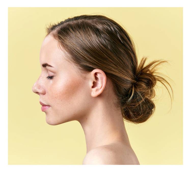 Juvederm Voluma