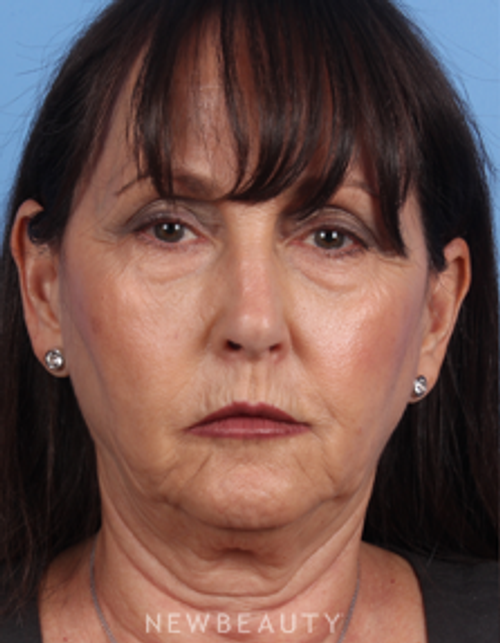 Dr. Kelly Bomer - Facelift - Before