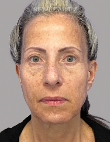 Dr. Dilip Madnani - Facelift -  45284088 - Before