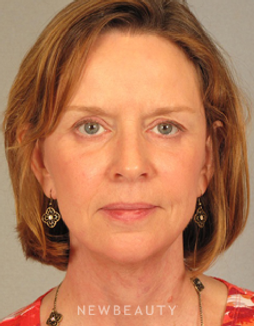 Dr. Henry Mentz Eyelift, Facelift, Necklift - After