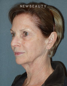 Dr. Min S. Ahn- Facelift - Before