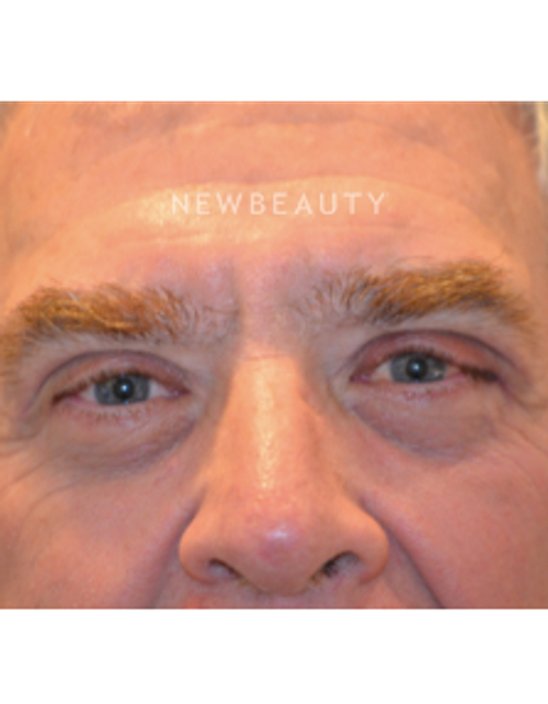 Dr. B. Aviva Preminger - Rejuvenated Eyes - After