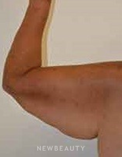 Dr. Aviva Preminger - Arm Lift - Before