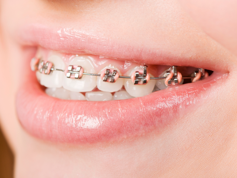 braces Main Newbeauty