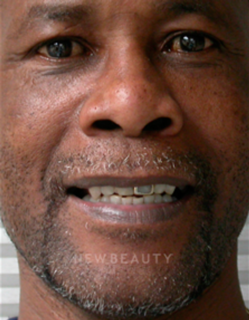 Dr. Irene Grafman Bonding, Crowns, Dentures - Before