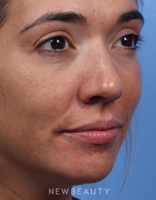 Dr. Kelly Bomer - Juvéderm - Before