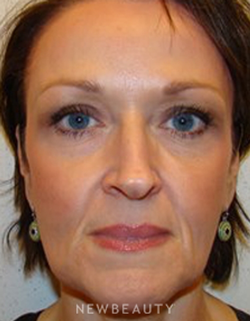 Dr. Joel Schlessinger - Botox - After