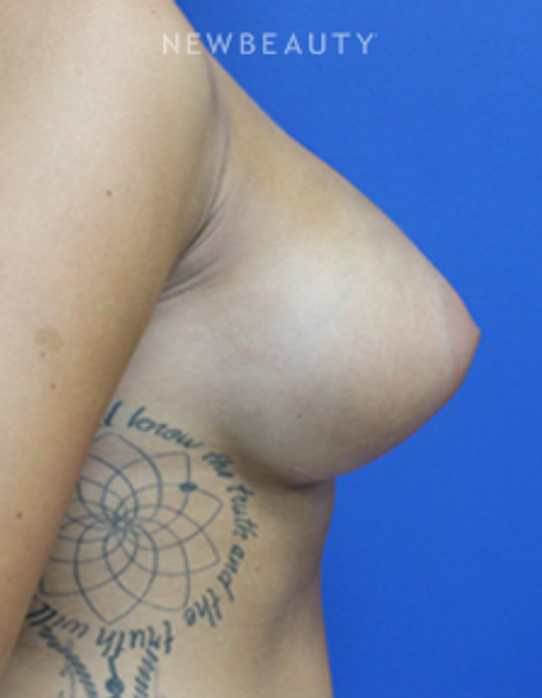Dr. Joseph Russo - Enhancing Curves (Breast EBG) - After