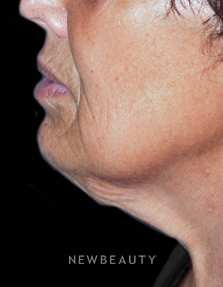 Dr. Roman Rayham - Restoring Youthfulness - Before