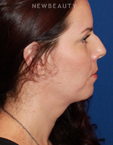 Dr. Dilip Madnani - Restylane - Before