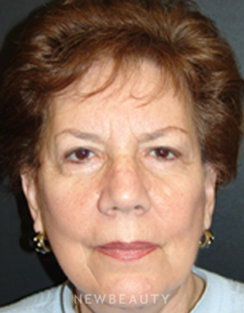 Dr. Mokhtar Asaadi Eyelid Lift, Facelift, Necklift - After