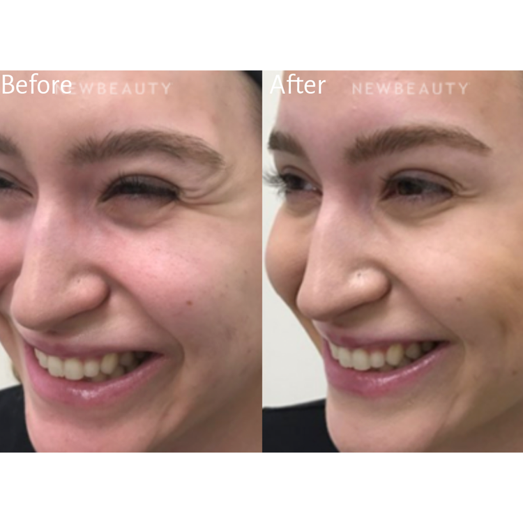 Reducing Crow's Feet Footprints