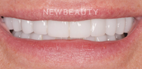Dr. Salvator La Mastra - Smile Makeover -46106655 - After