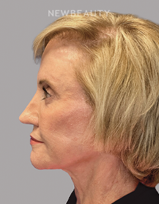 Dr. Paul Afrooz - Beautiful Transformation - 36269784 - After