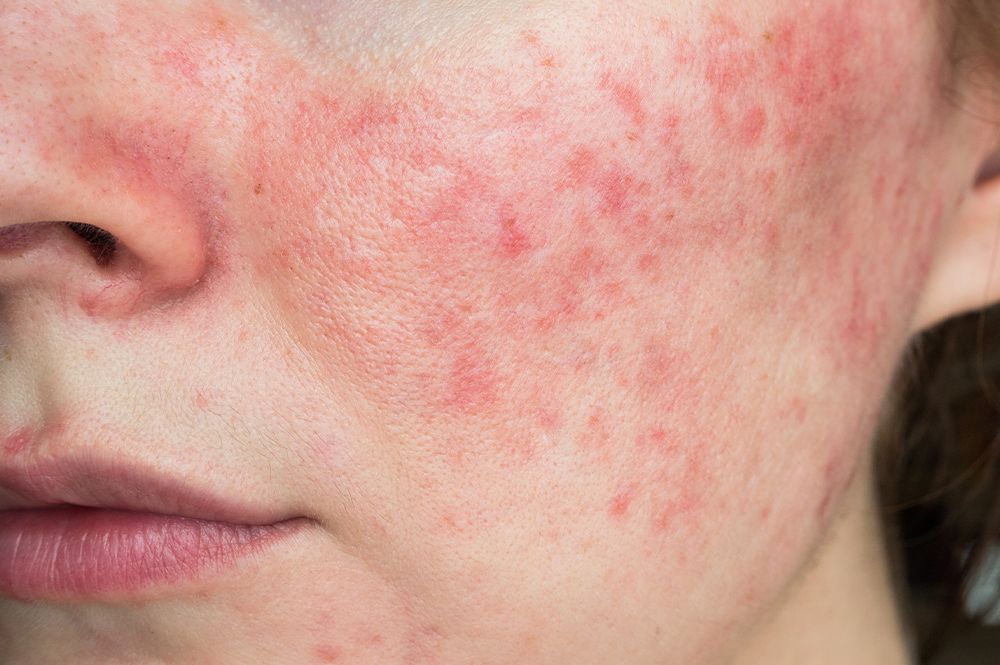 The Best Expert-Approved Rosacea Tips and Treatments to Try Next