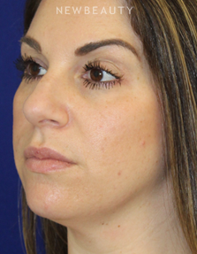 Dr. Dilip Madnani - Facial Rejuvenation - 12950645 - Before