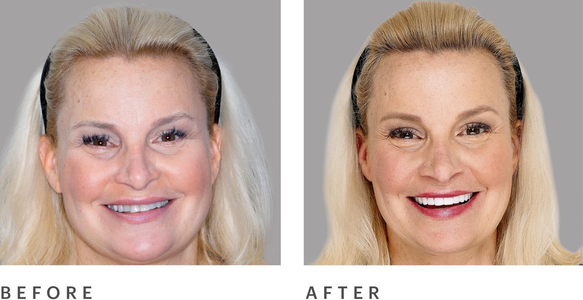 before and after teeth whitening
