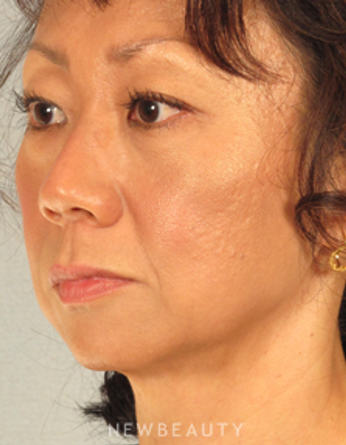 Dr. Henry Mentz - Limited Incision Facelift - Before