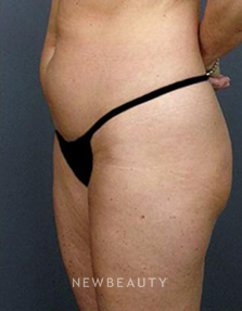 Dr. Roman Rayham - Toned and Sculpted - Before