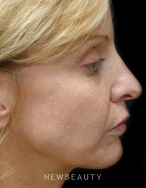 Dr. Mokhtar Asaadi Eyelid Lift, Facelift, Necklift - Before