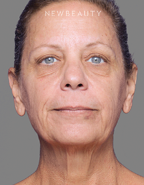 Dr. Alan Durkin - Facelift with Fat Transfer - Before