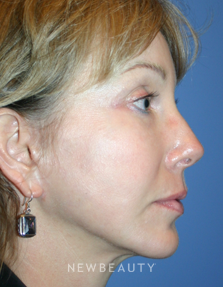 Dr. Kelly Bomer, Facelift - After