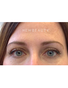 Dr. Julie Russak - Injectables & Fillers - After