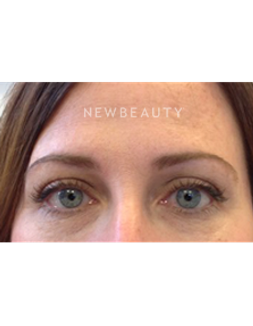 Dr. Julie Russak - Injectables & Fillers - After