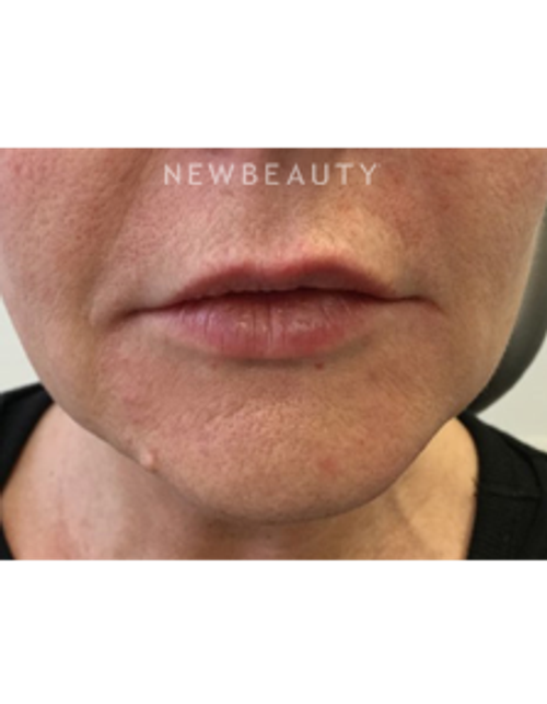 Dr. Julie Russak - Defining Beauty - After