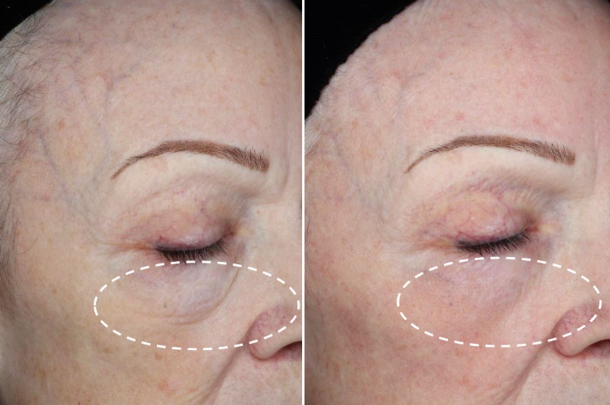 BEFORE / AFTER | Results 21 days post-treatment with Exo Booster.