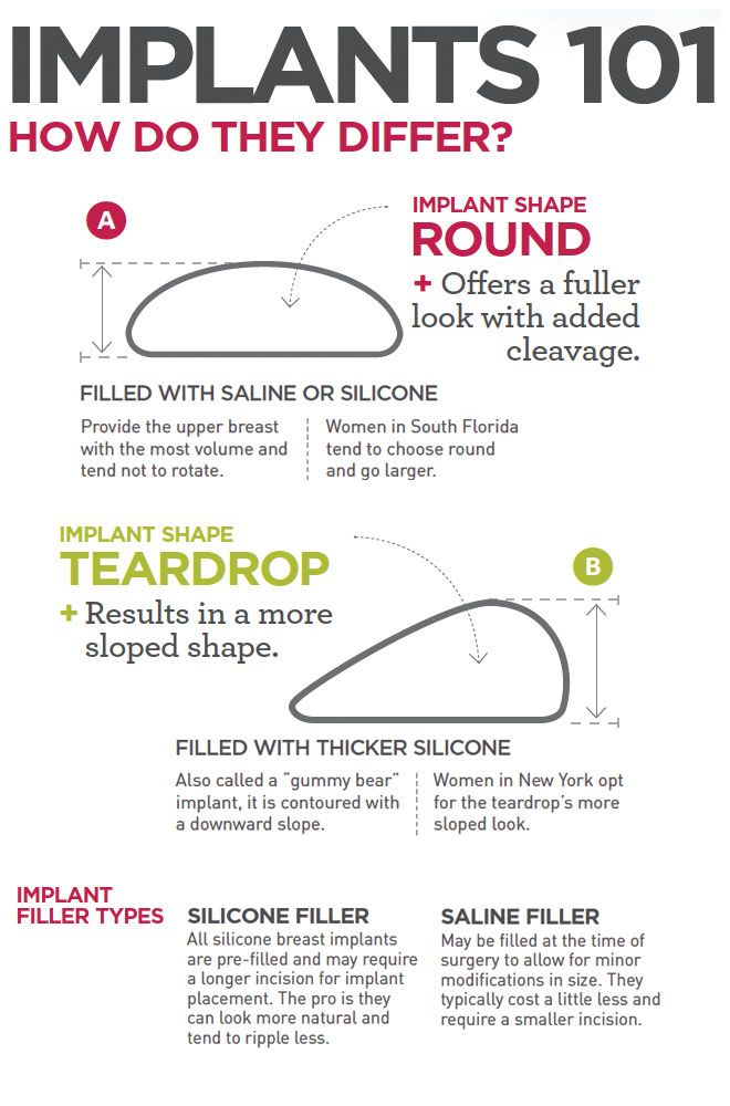 Infographic Implants101